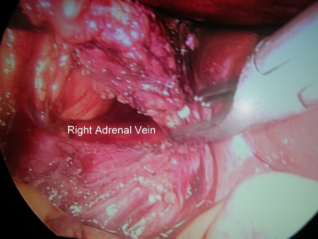 LAPAROSCOPIC ADRENALECTOMY RIGHT SIDE